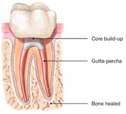 Root canal treatment in Marathahalli