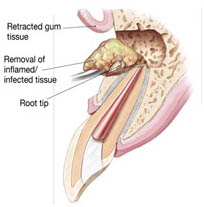 Root canal specialist in Brookfield