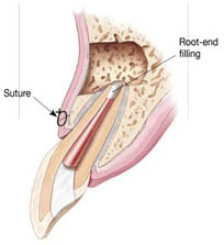 Root canal specialist in Whitefield