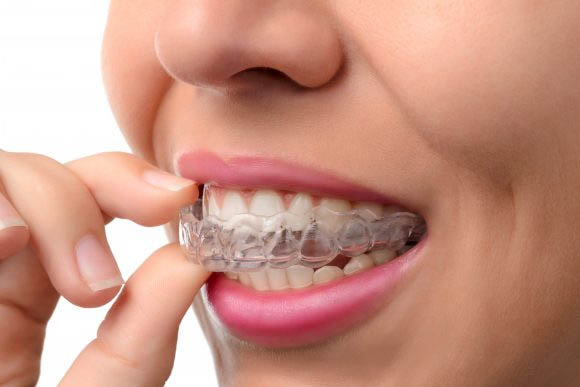 Invisalign Braces in Whitefield