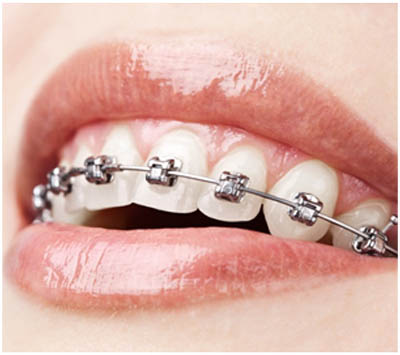 Top Orthodontist in Brookfield