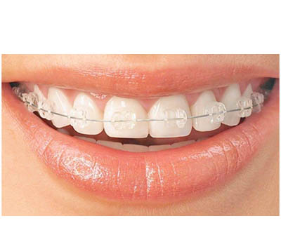 Best Orthodontist in Marathahalli