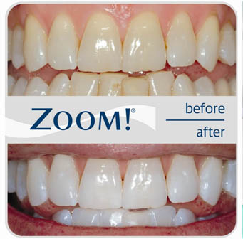 Teeth Whitening in Whitefield