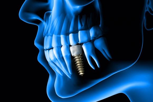 Implant dentist in whitefield
