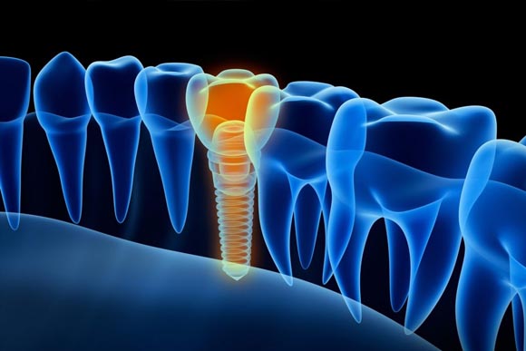 Dental Implants in Brookfield