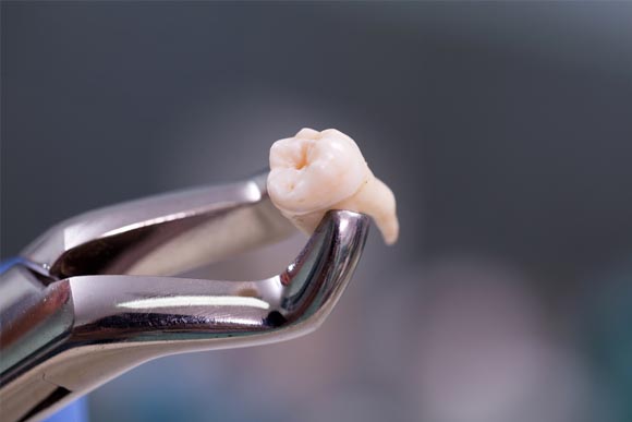 Wisdom teeth removal in Marathahalli