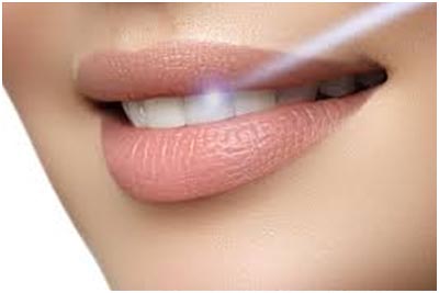 Laser Dentistry in Marathahalli