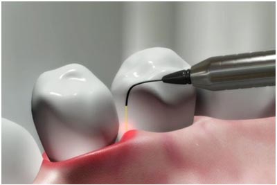 Laser Dentistry in Brookfield