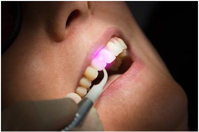 Laser Dentistry in Whitefield