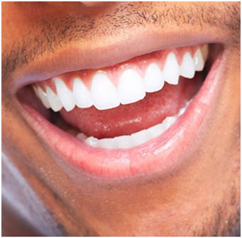 Teeth Whitening Services in Marathahalli