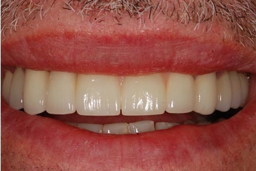 Smile Makeover in AECS Layout