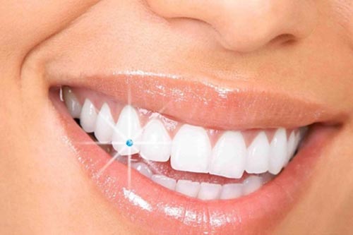 Smile Makeover in Whitefield