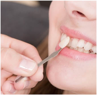 Dental Veneers in AECS Layout