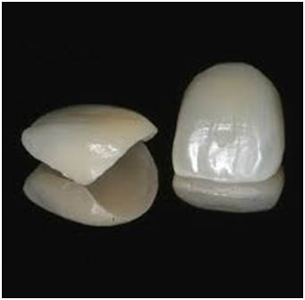 Dental Veneers in Marathahalli