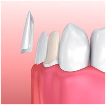 Dental Veneers in Brookfield